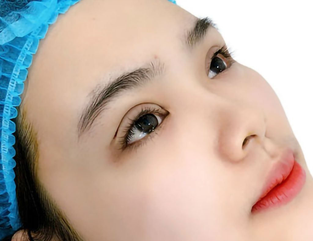 Cắt mí sẽ tạo ra nếp mí rõ