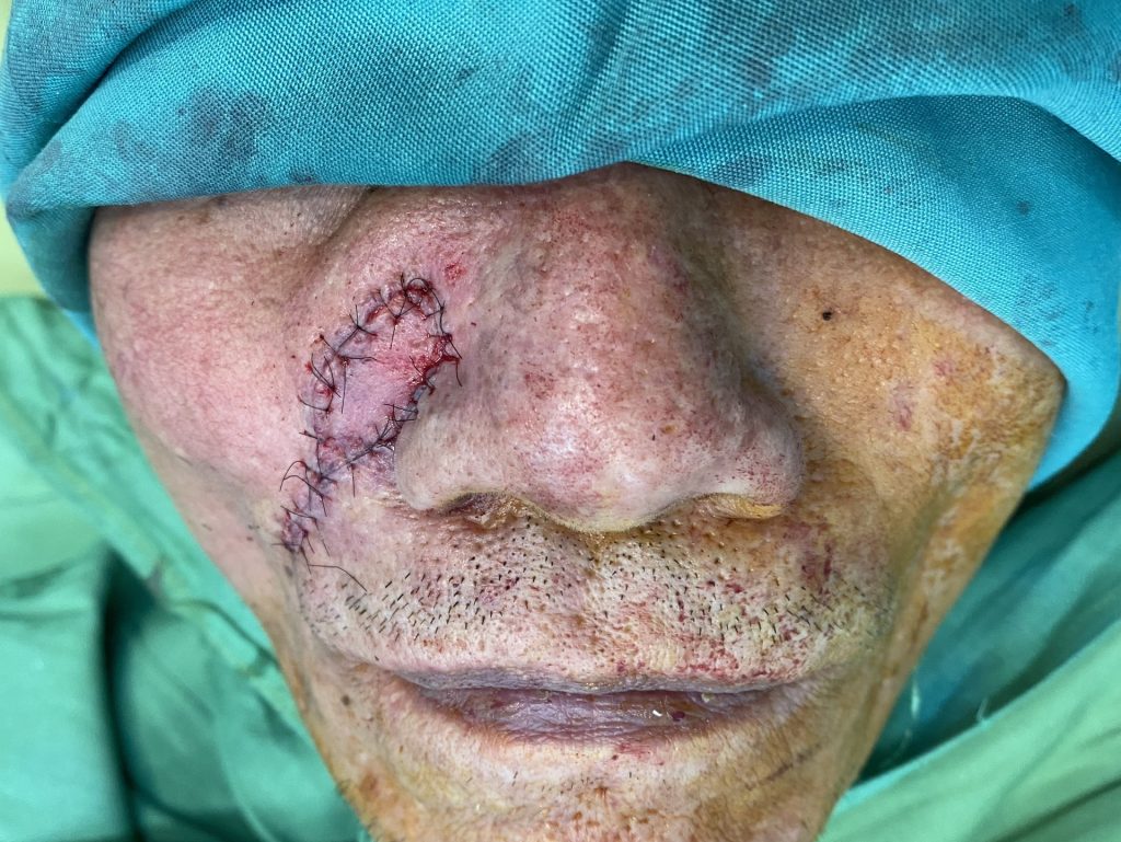 Ung thư da vùng mặt