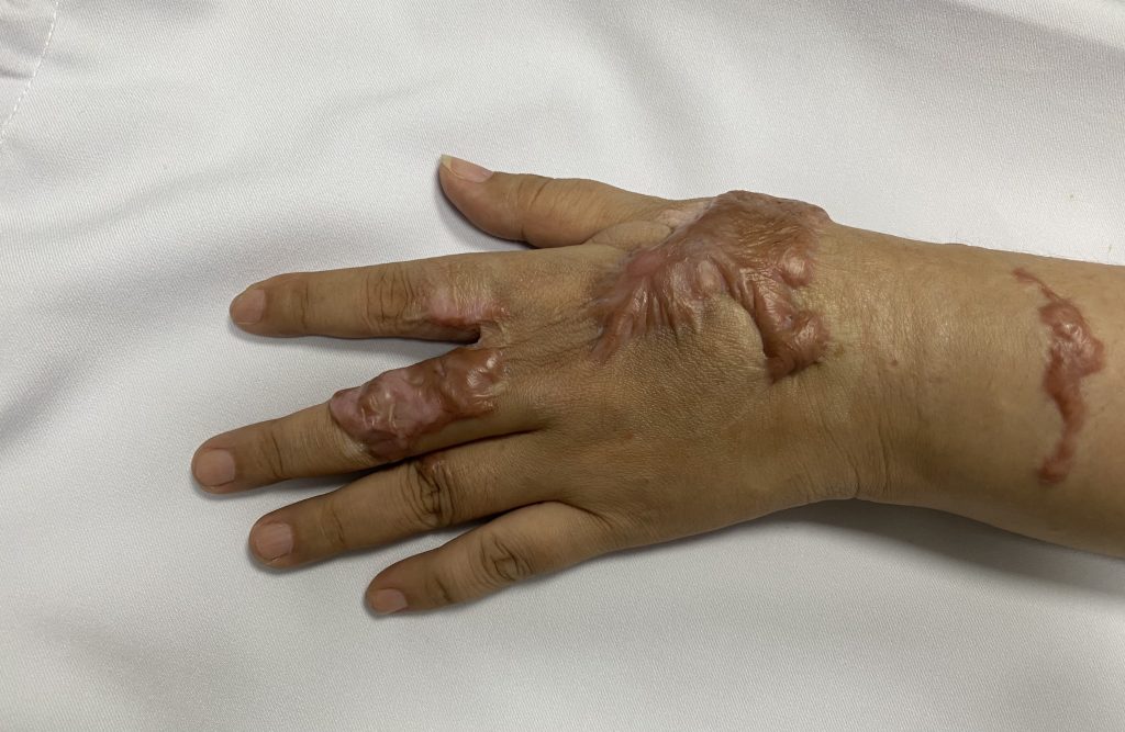 Sẹo phì đại và sẹo lồi khác nhau như thế nào