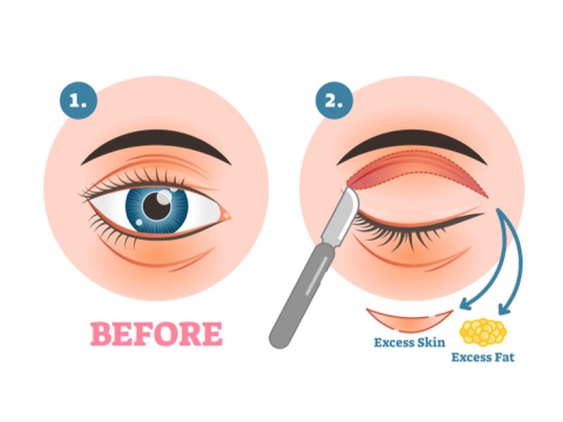 Lấy mỡ thừa mí mắt trên là 1 tiểu phẫu khá đơn giản và không gây đau đớn