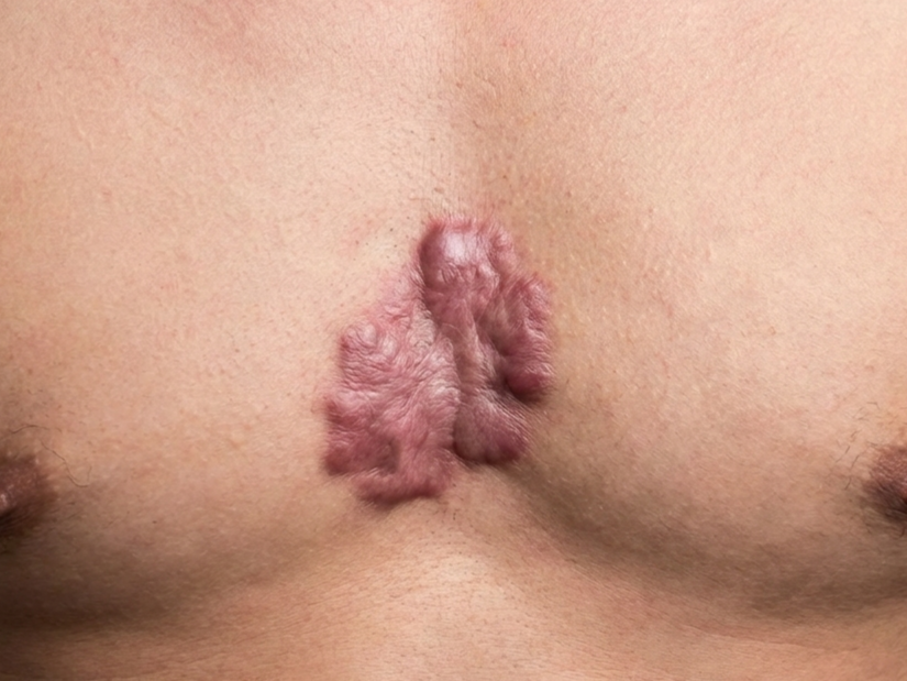 Điều trị sẹo lồi