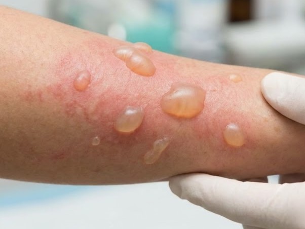 So cứu đúng cách sẽ hạn chế sẹo sau bỏng