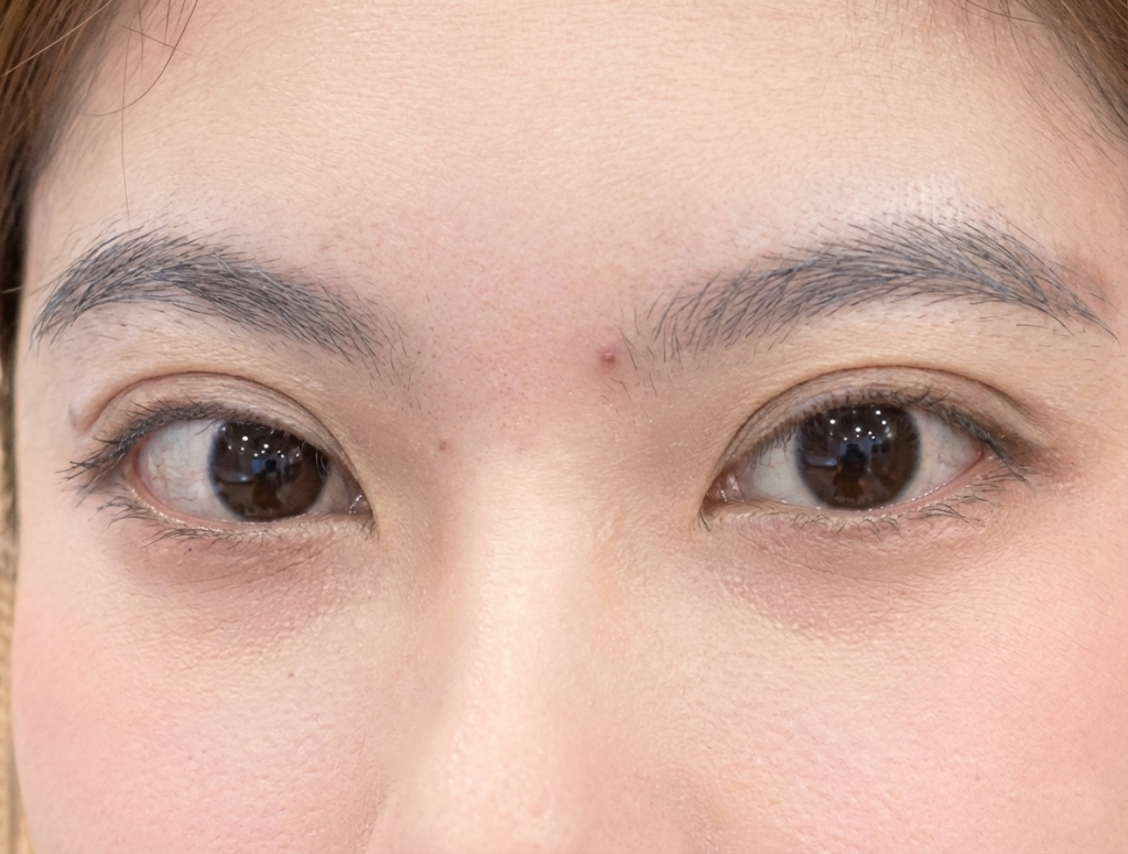 Cắt mí cần kiêng gì và lưu ý những gì