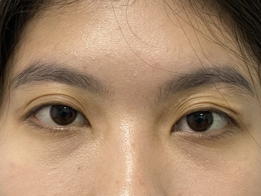 Cắt mí cần kiêng gì và lưu ý những gì