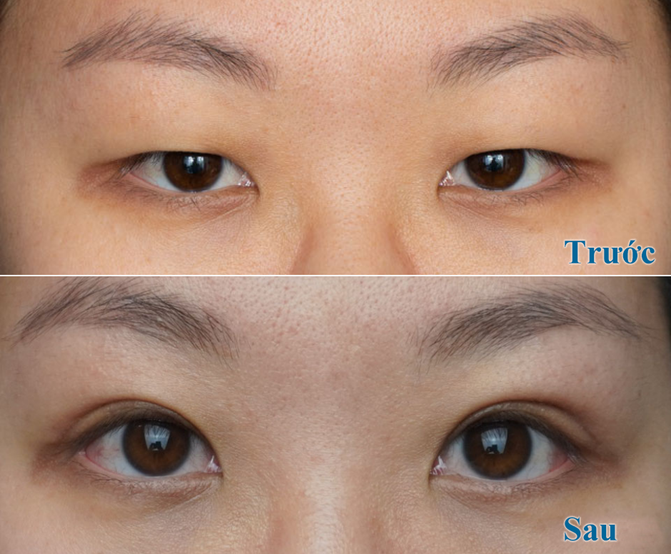 Mở rộng góc mắt giúp mắt to, tròn và cân đối