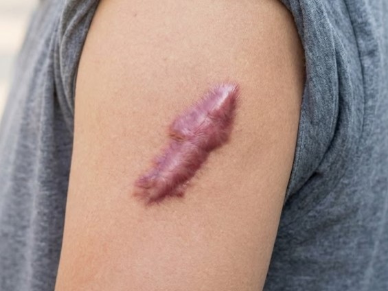 Sẹo lồi do bỏng ở cánh tay