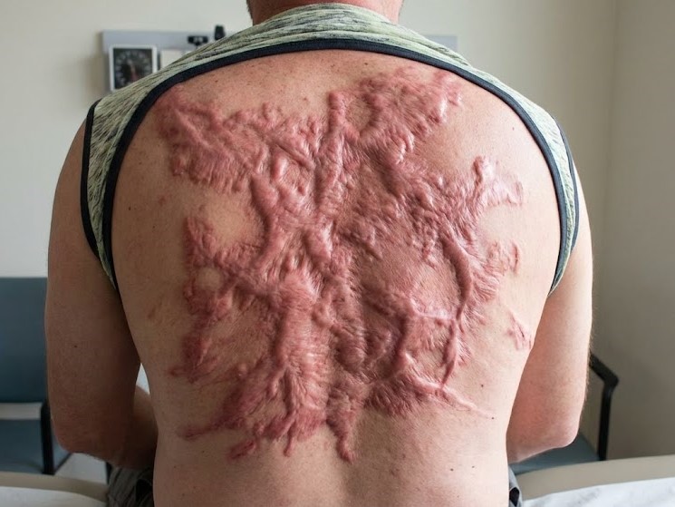 Sẹo bỏng phì đại ở lưng