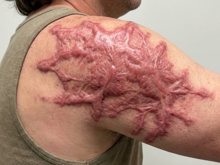 Sẹo bỏng phì đại ở vai