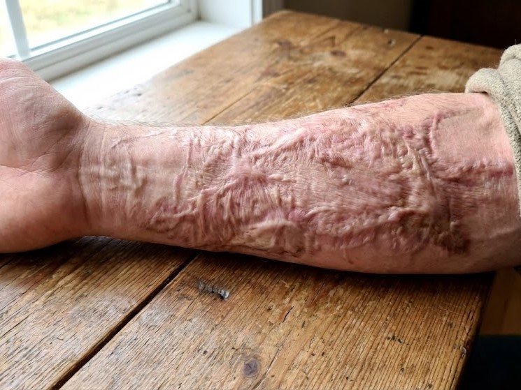 Sẹo do bỏng ở tay