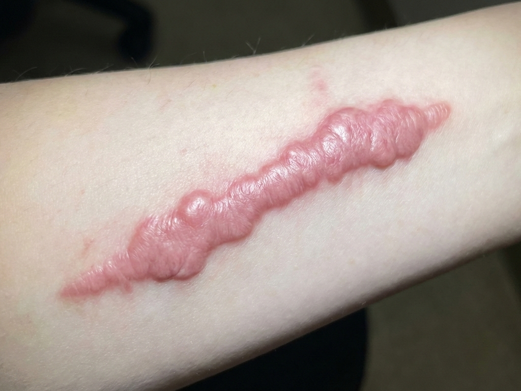 Sẹo phì đại cẳng tay trái