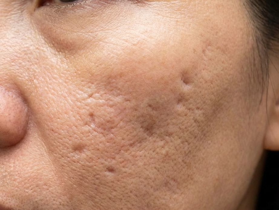 Điều trị sẹo lõm bằng công nghệ mới