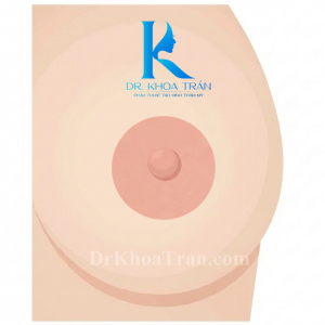 Bạn đang tự ti ví quầng vú dãn to?