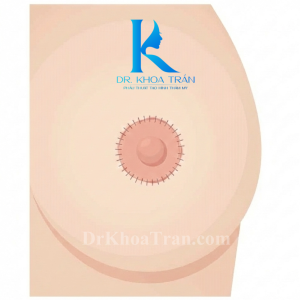 Không phải cứ thu nhỏ quầng vú là auto đẹp!?