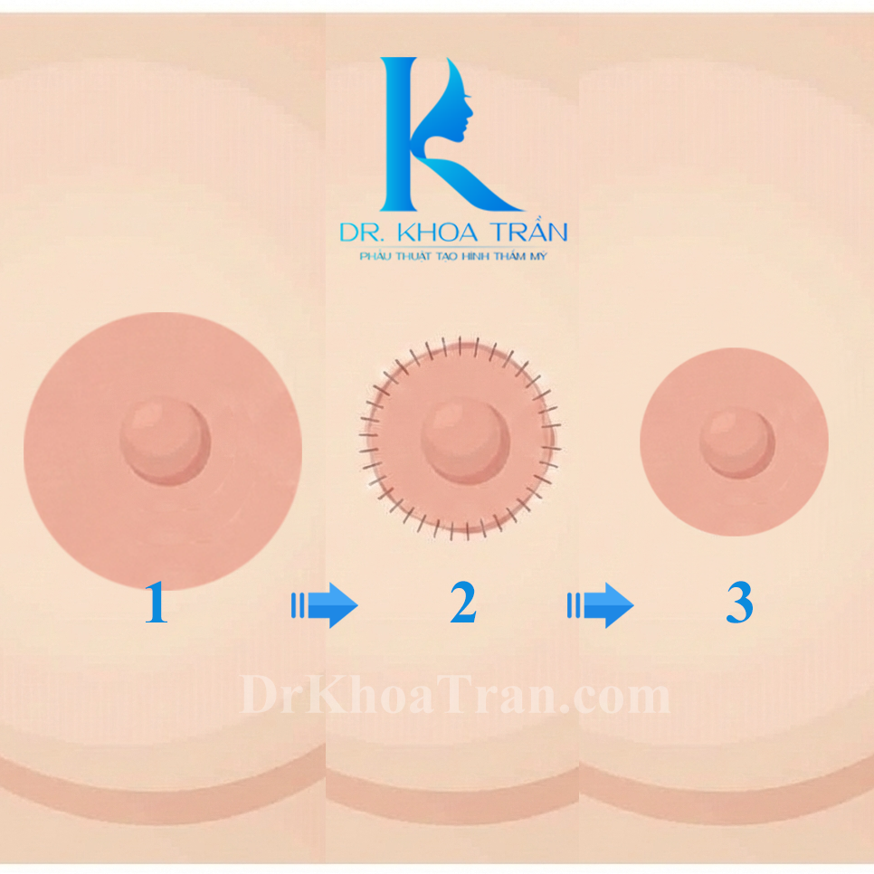 Thu nhỏ quầng vú - lựa chọn trước khi thực hiện