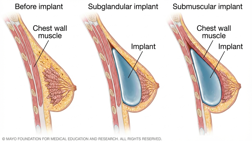Nâng ngực là gì
