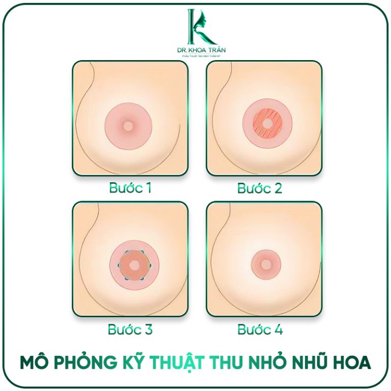 Thu Nhỏ Quầng Vú — Giải Pháp Cho Quầng Ngực To