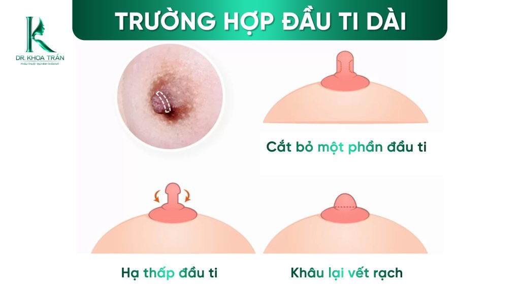 Hạ thấp đầu ti - trường hợp đầu ti dài