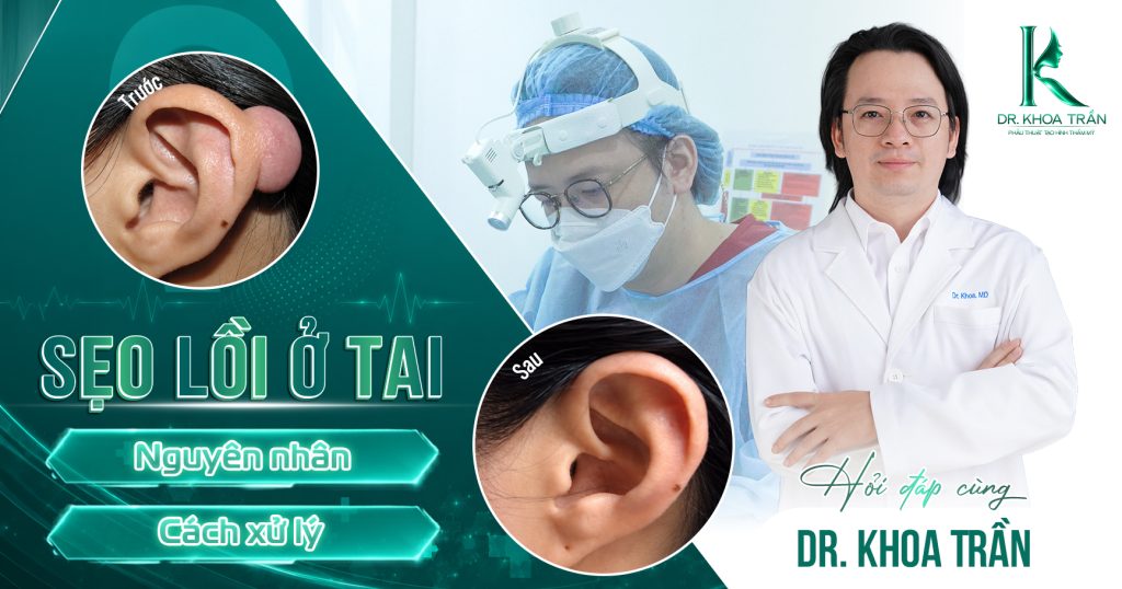 Sẹo lồi ở tai - Nguyên nhân và cách xử lý