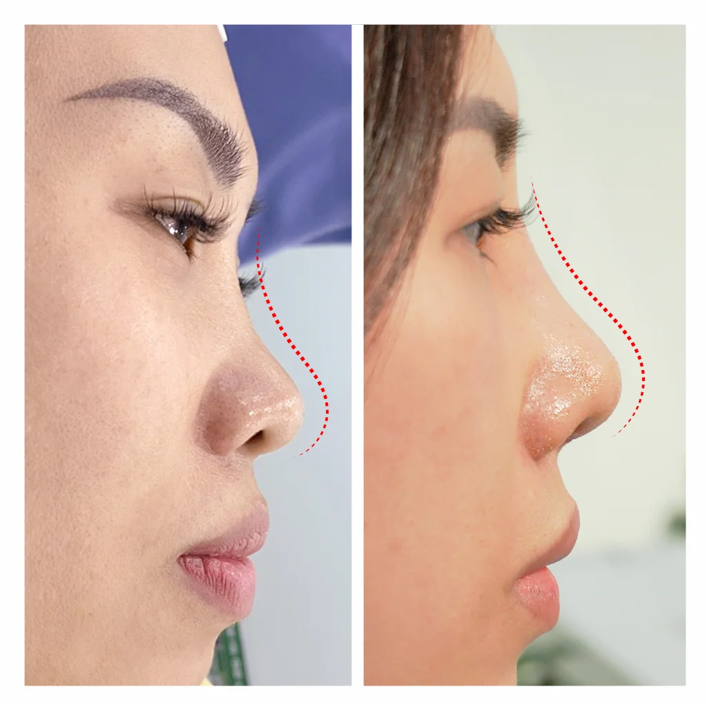 Nâng Mũi Thẩm Mỹ