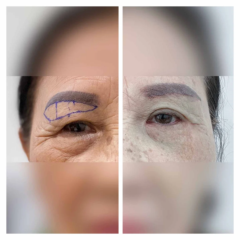 Nâng Cung Chân Mày