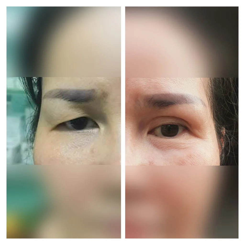 Nâng Cung Chân Mày